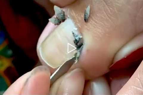 HOW TO CUT THICK TOENAILS  - Toenail Cleaning Satisfying #22