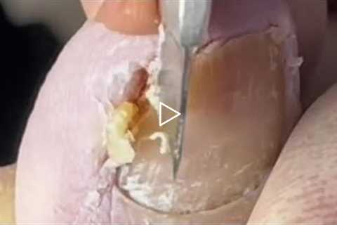 Professional pedicure video: pulling out huge ingrown nails【Crazy pedicure room】