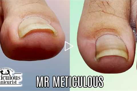 👣Big Toes Only - IMPACTED TOENAIL Gunk Removal on Mr. Meticulous👣