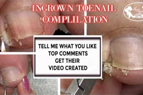 Pedicure Ingrown Toenail Relief Compilation with Slo Motion