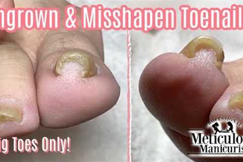 👣Big Toes Only - Squeezed Ingrown Toenail Pedicure How To Transformation👣