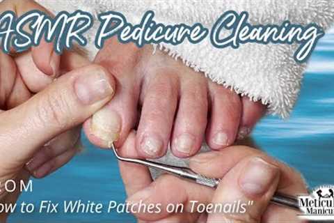 👣ASMR Pedicure Cleaning💆‍♀️How to Fix White Patches on Toenails👣