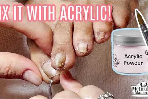 👣 How to use Acrylic to Fix a Pincer Toenail Tutorial👣