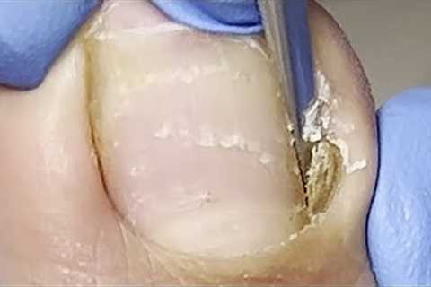 Ingrown at the base of the toenail, very deep【Xue Yidao】