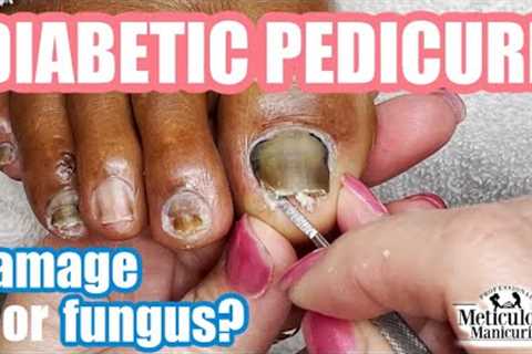 👣Diabetic Pedicure: Toenail Damage or Nail Fungus?👣