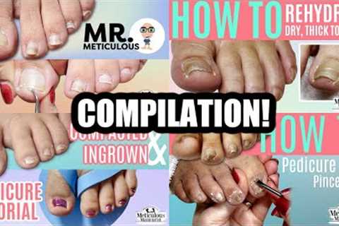 👣Pedicure Compilation on Impacted, Ingrown, and Pincer Toenails (Part 1)👣