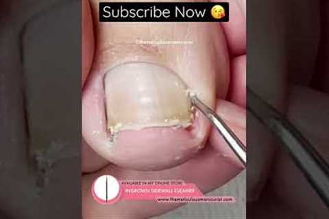 I can’t stop watching this video! #satisfying #ingrowntoenail #pedicure #pedicuretraining
