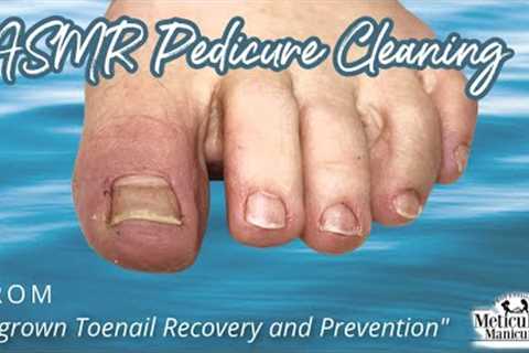 👣ASMR Pedicure Cleaning💆‍♀️Ingrown Toenail Recovery and Prevention👣