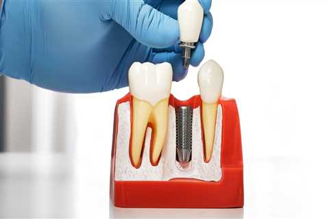What is the typical timeline for the dental implant procedure