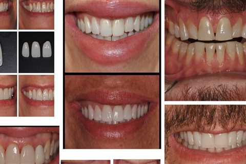The Art of Smile Makeovers: Expert Cosmetic Dentist Insights