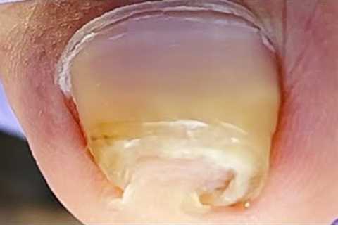 Curly ingrown toenails leave huge damage to toes【Xue Yidao】