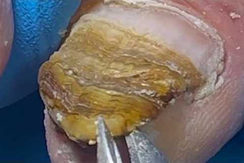Nails are almost completely infected by bacteria, perfect removal【Pedicure King】